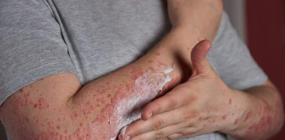 COFEPRIS aprueba tratamiento para aliviar la psoriasis